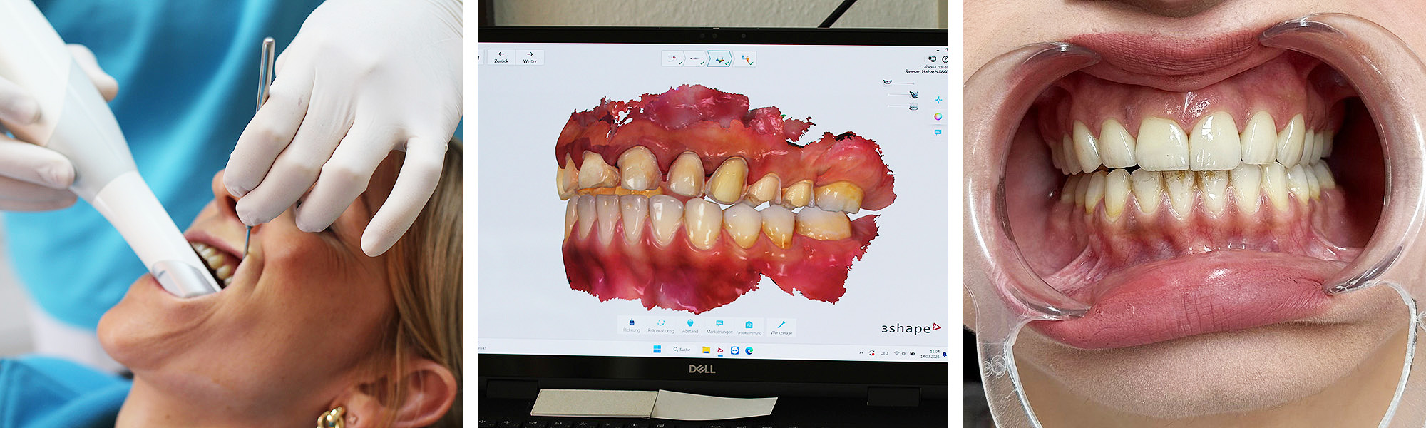 Verschiedene Szenen der Anwendung einer intraoralen Kamera: Eine Zahnärztin führt die Kamera im Mund eines Patienten, daneben ist auf einem Bildschirm das detaillierte Bild eines Zahnbereichs zu sehen