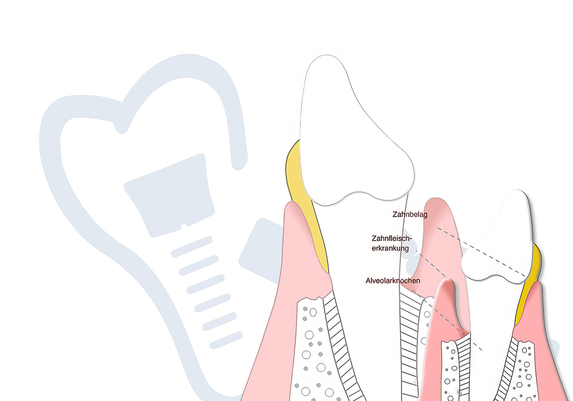 Illustration eines Zahns mit sichtbarem Zahnbelag und entzündetem Zahnfleisch, zur Veranschaulichung von Parodontitis