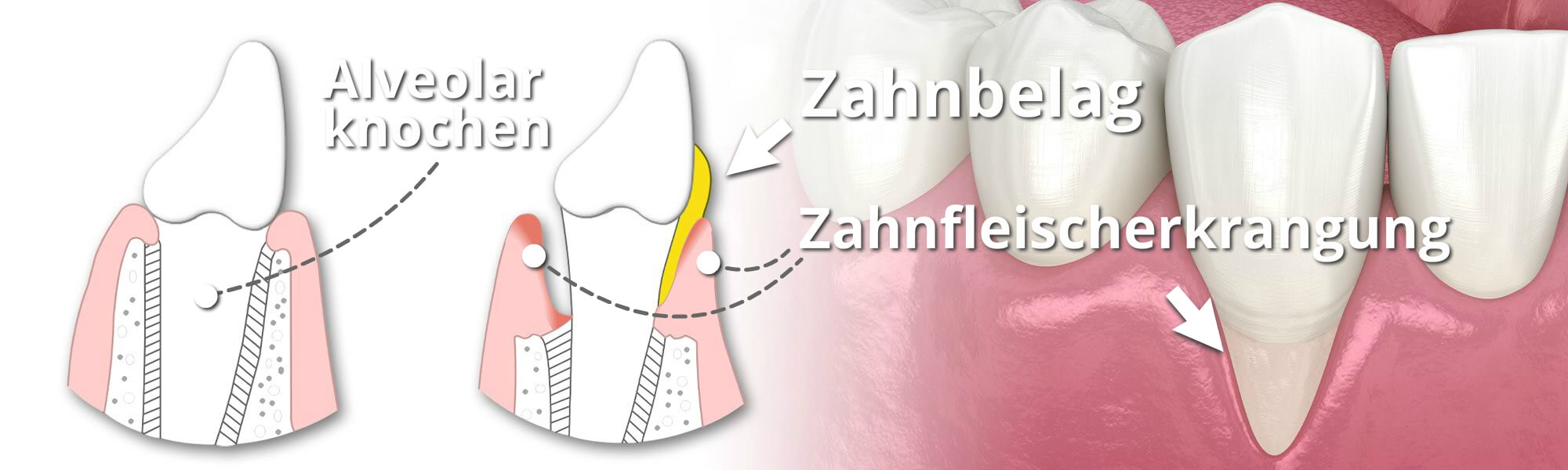 Illsutration einer Parodontalchirurgie