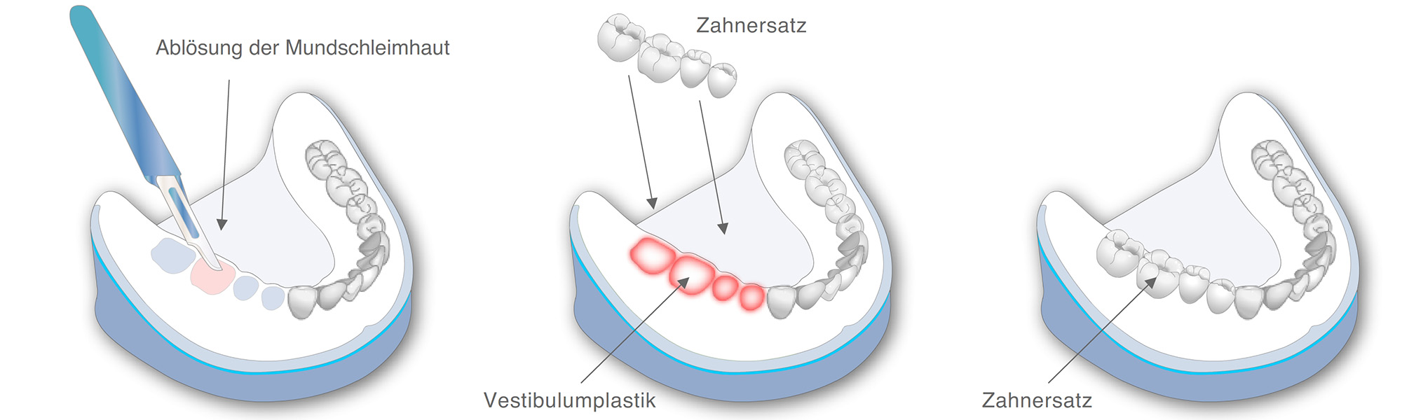 Präprothetische Chirurgie
