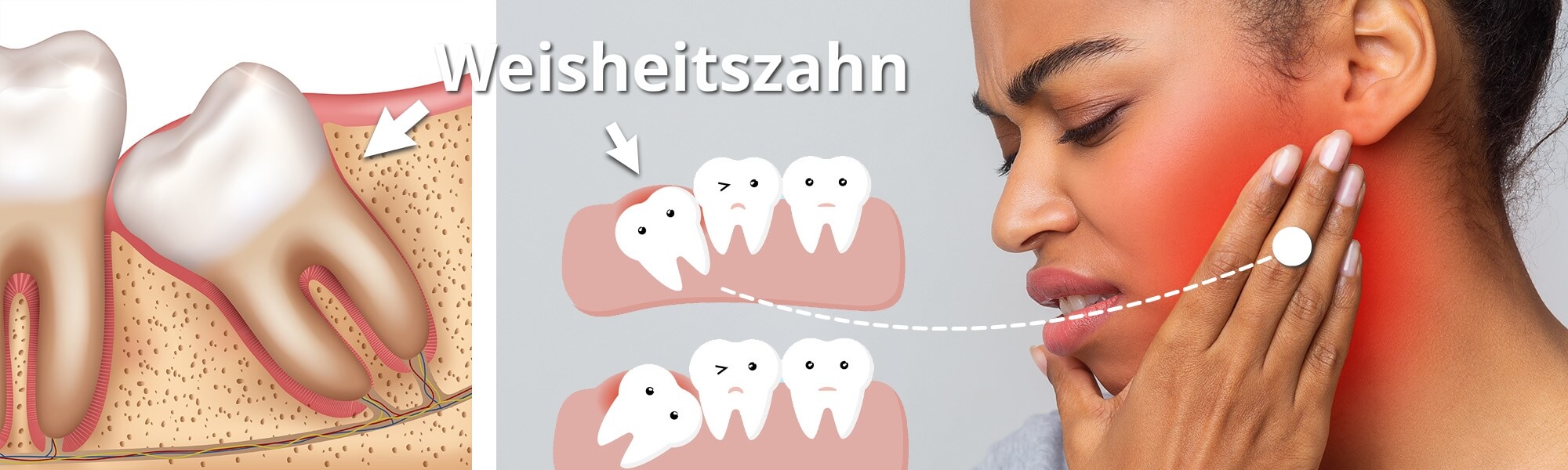 Links eine Illustration einer Ansicht und Lage des Weisheitszahnes, rechts eine Frau mit Zahnschmerzen die sich die Wange festhält