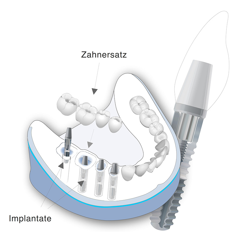 Vorschaubild - Behandlungsmethode der Verkürzten Zahnreihe