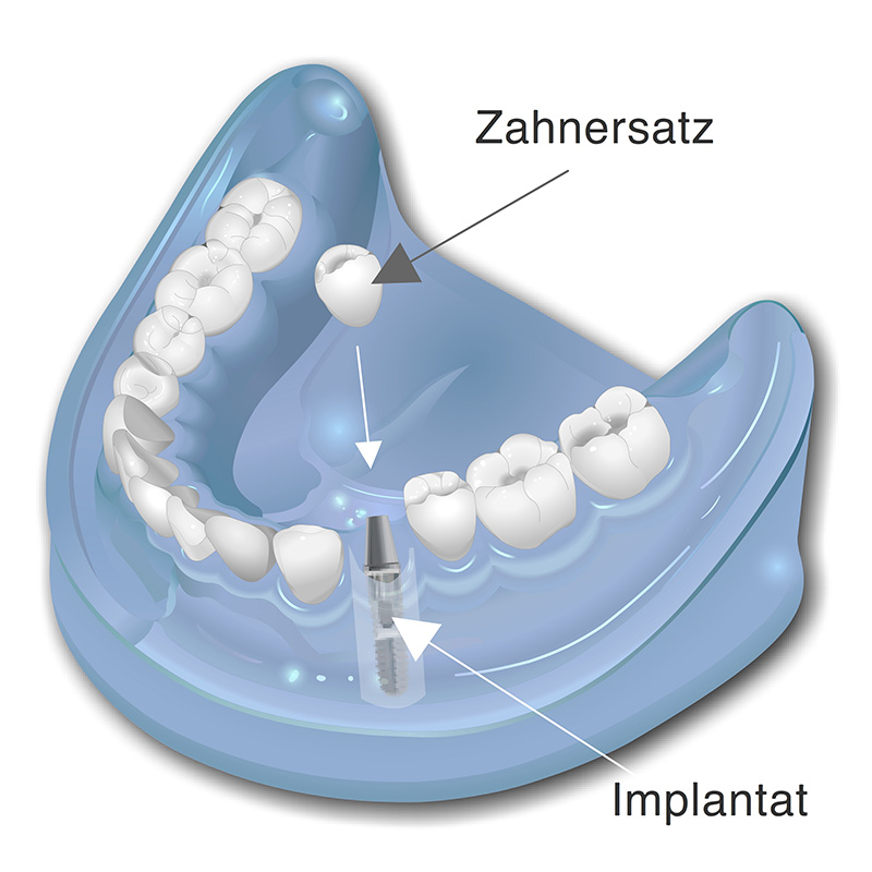 Implantatgetragener Zahnersatz
