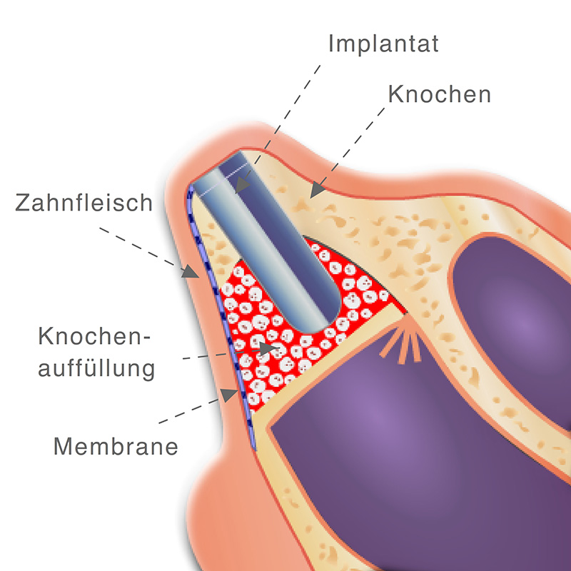 Vorschaubild - Animation einer Zystenentfernung