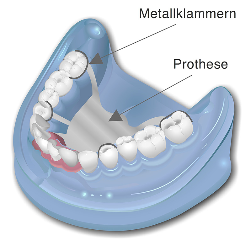 Modellgussprothese
