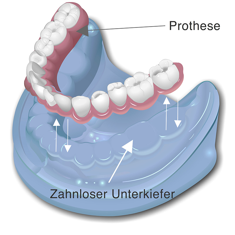 Totalprothese