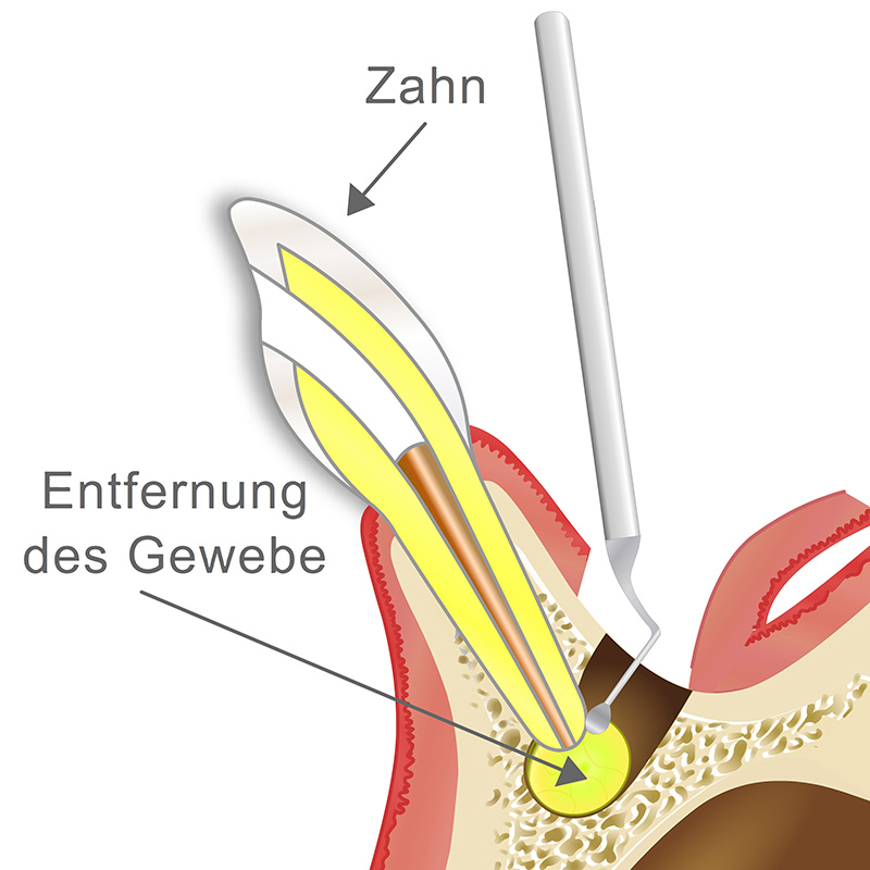 Vorschaubild - Animation Wurzelspitzenresektion