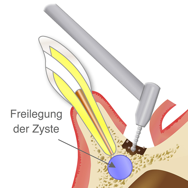 Vorschaubild - Animation einer Zystenentfernung